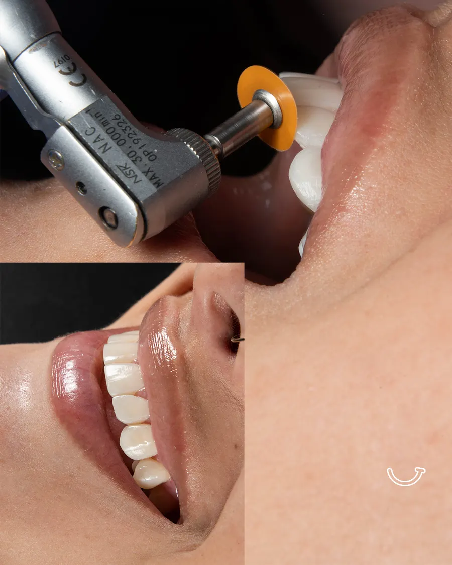 Resultado diseño de sonrisa — odontóloga estética Bogotá