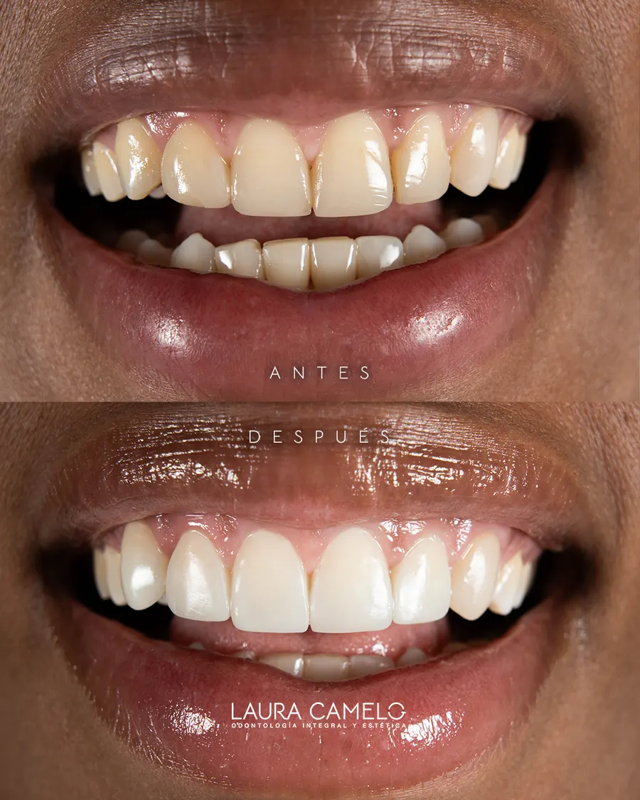 Rehabilitación oral — caso clínico Laura Camelo