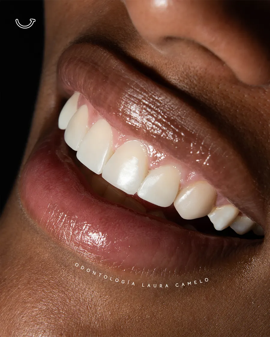 Rehabilitación dental completa — coronas en zirconio Bogotá