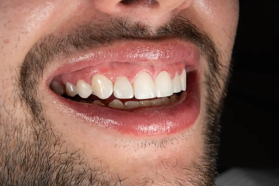 Aclaramiento dental profesional — resultado blanqueamiento Bogotá