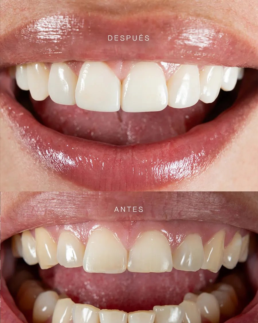 Lentes cerámicos mínima invasión — resultado profesional Bogotá